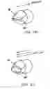 Fig. 14 - Sealing nasal devices for use while sleeping