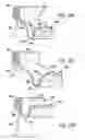 Fig. 11 - Full aperture beverage end