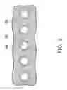 Fig. 06 - MEMS device with protection rings