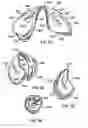 Fig. 30 - Collapsible structures having enhancements