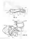 Fig. 07 - Canal hearing device with disposable battery module