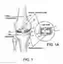 Fig. 02 - Tissue Engineered Meniscus Repair Composition