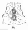 Fig. 02 - Method of treating anal incontinence
