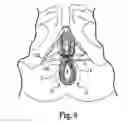 Fig. 06 - Method of treating anal incontinence