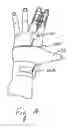 Fig. 13 - Functional low-profile dynamic extension splint and methods for its use and manufacture