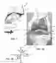 Fig. 02 - Implants with transition surfaces and related processes