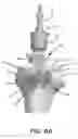 Fig. 09 - Implants with transition surfaces and related processes