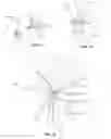 Fig. 15 - Facet Joint Implant and Related Methods