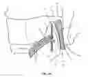 Fig. 24 - Facet Joint Implant and Related Methods