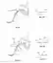 Fig. 25 - Facet Joint Implant and Related Methods