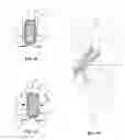 Fig. 31 - Facet Joint Implant and Related Methods