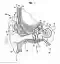 Fig. 02 - DETERMINING STIMULATION LEVEL PARAMETERS IN IMPLANT FITTING