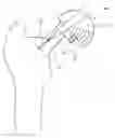 Fig. 01 - Instrument for use in a joint replacement procedure
