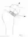 Fig. 04 - Instrument for use in a joint replacement procedure