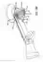 Fig. 34 - Adjustable absorber designs for implantable device