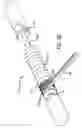Fig. 46 - Adjustable absorber designs for implantable device