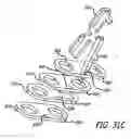 Fig. 55 - Adjustable absorber designs for implantable device