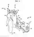 Fig. 02 - Using a genetic algorithm employing an expedited convergence mechanism to at least partially fit a medical implant to a patient using patient feedback