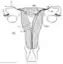 Fig. 01 - MINIMALLY INVASIVE DELIVERY DEVICES AND METHODS