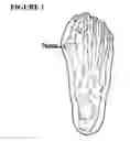 Fig. 02 - STOCKING FOR FEET WITH BUNIONS
