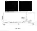 Fig. 06 - Diagnosing and Grading Gliomas Using a Proteomics