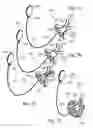 Fig. 07 - Adjustable tension ring for amelioration of urinary incontinence in females