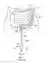 Fig. 02 - Steerable segmented endoscope and method of insertion