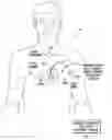 Fig. 01 - SYSTEM AND METHOD FOR USE WITH AN IMPLANTABLE MEDICAL DEVICE FOR DETECTING STROKE BASED ON PHYSIOLOGICAL AND ELECTROCARDIAC INDICES