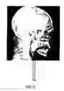 Fig. 07 - System and Method for Three-Dimensional Airway Reconstruction, Assessment and Analysis
