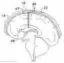 Fig. 01 - INTRACRANIAL PRESSURE SENSOR