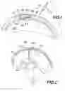 Fig. 02 - INTRACRANIAL PRESSURE SENSOR