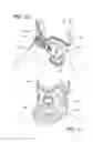Fig. 06 - Cervical collar with reduced vascular obstruction