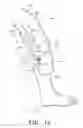 Fig. 12 - Orthosis