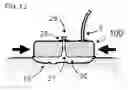 Fig. 10 - DEVICE FOR TRACTION WOUND CLOSURE
