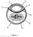 Fig. 05 - Non-invasively adjustable drainage device