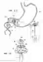 Fig. 09 - GASTRIC ANCHOR