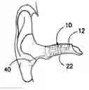 Fig. 01 - Ear insert for relief of TMJ discomfort and headaches