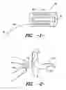Fig. 02 - Ear insert for relief of TMJ discomfort and headaches