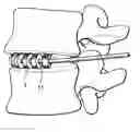 Fig. 01 - Expandable ring intervertebral fusion device