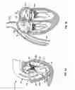 Fig. 02 - Methods, systems and devices for cardiac valve repair