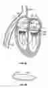 Fig. 06 - Methods, systems and devices for cardiac valve repair