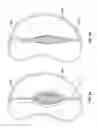 Fig. 09 - Methods, systems and devices for cardiac valve repair