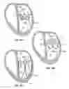 Fig. 22 - Methods, systems and devices for cardiac valve repair