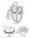 Fig. 28 - Methods, systems and devices for cardiac valve repair