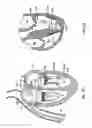 Fig. 32 - Methods, systems and devices for cardiac valve repair
