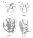 Fig. 40 - Methods, systems and devices for cardiac valve repair