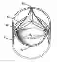 Fig. 01 - Prosthetic tissue valve