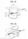 Fig. 06 - Minimally invasive intervertebral staple distraction devices