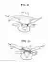 Fig. 08 - Minimally invasive intervertebral staple distraction devices