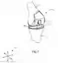 Fig. 02 - Position adjustable trial systems for prosthetic implants